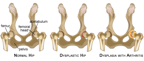 hipdysplasia_labeled_bekki2